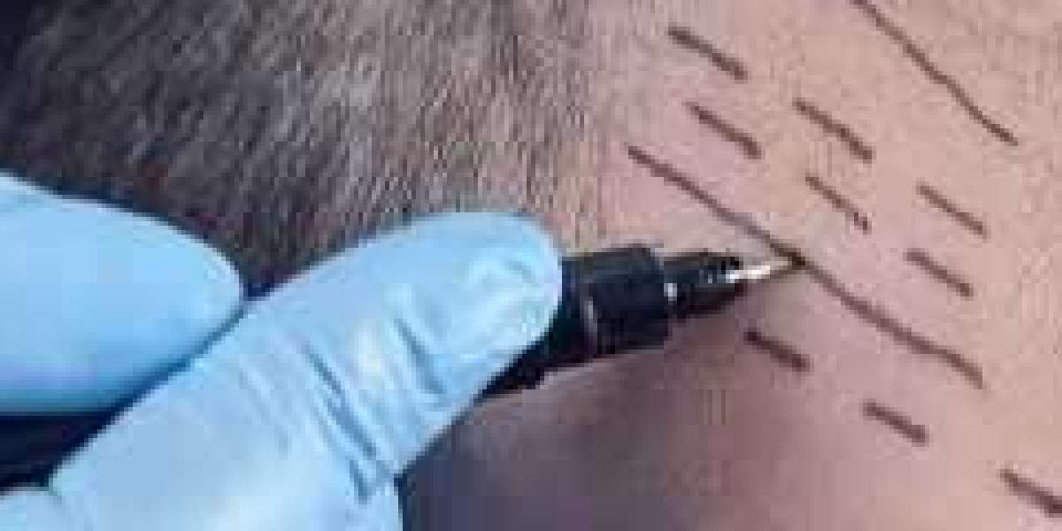Explore the best Dubai hair transplant trends of 2025 through a