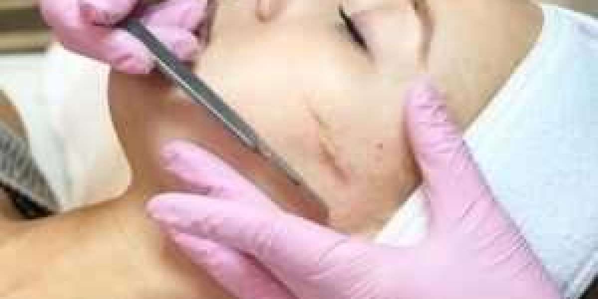 Microneedling Treatment for Face in Chelsea, London — Benefits for Face, Hair, Acne Scars & Stretch Marks